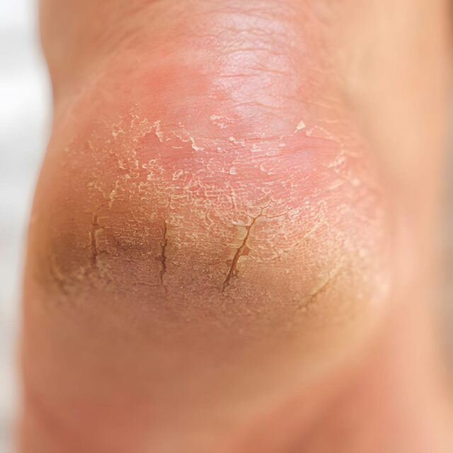 In Awe Blog: How to Heal Cracked Heels