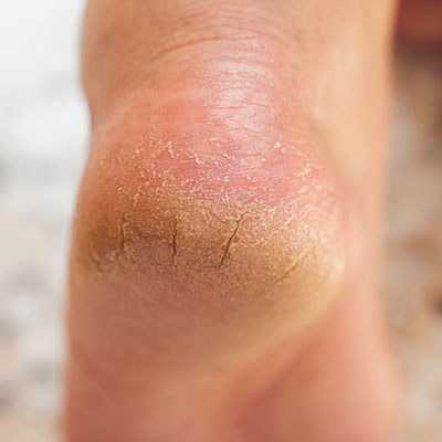 News: How to Heal Cracked Heels