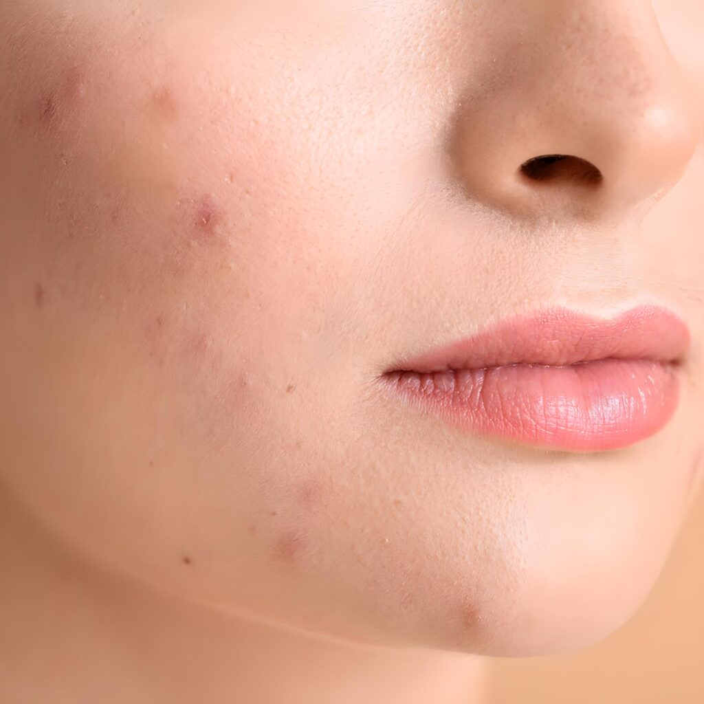 In Awe Blog: Benefits of In Awe on Acne-prone Skin