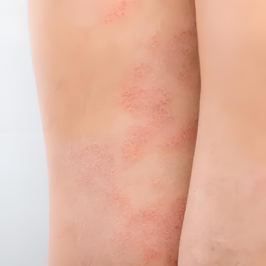 In Awe Blog: Eczema Relief